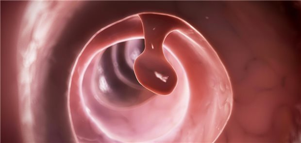 Dreidimensionale gerenderte Illustration eines Dickdarmlipoms.