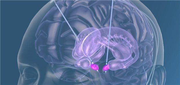 Tiefe Hirnstimulation.