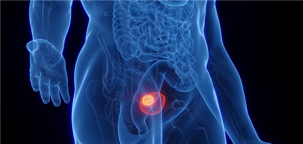 Dreidimensionale gerenderte medizinische Illustration von Blasenkrebs bei einem Mann.