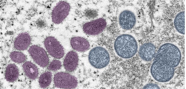 Digital gefärbte EM-Aufnahme von Affenpockenvirionen: Bekannt sind in Deutschland bisher 3607  Infektionsfälle in diesem Jahr.