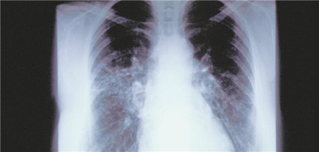 Röntgenbild einer Lungenfibrose