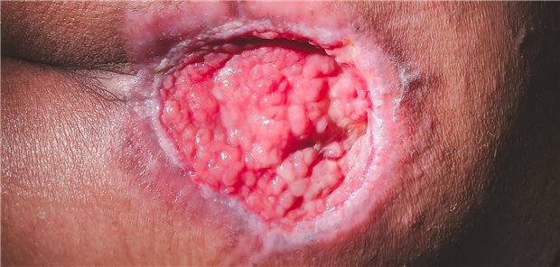 Druckulzera kommen besonders gern bei immobilisierten Menschen vor. Damit sie gar nicht erst auftreten, können neben Mobilisation und Lagerungswechsel auch druckverteilende Unterlagen oder ein Ernährungsplan helfen.