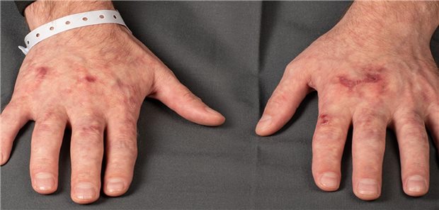 Ein 28-jähriger Patient stellt sich mit blitzfigurenartigen, nicht wegdrückbaren, erythematös-lividen Makulae vor. Hinter der Livedo racemosa vermuteten die Ärzte eine seltene hereditäre Stoffwechselstörung als Ursache.