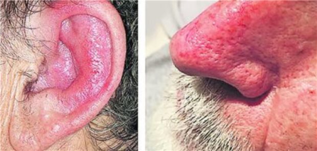 Ein VEXAS-Syndrom sollte bei allen älteren männlichen Patienten mit inflammatorischen Hautveränderungen und Makrozytose erwogen werden, empfiehlt ein Kollege beim europäischen Derma-Kongress.