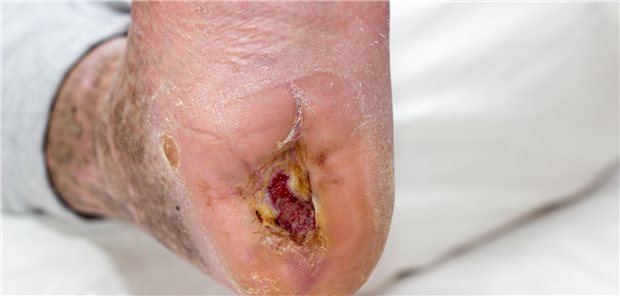 Patient mit nicht heilender Wunde am Fuß