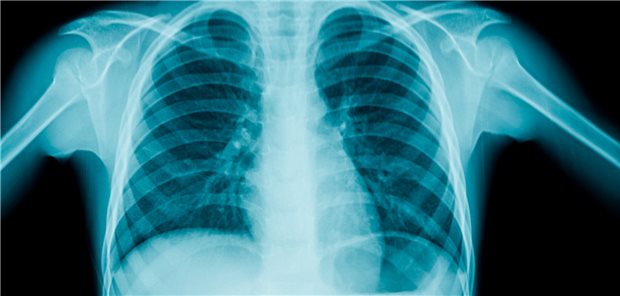 Pneumonie bei Kindern ausschließen: Auf das Röntgenbild ist offenbar Verlass Röntgenbild des Thorax eines Kindes.