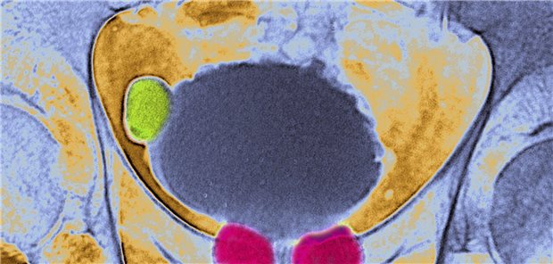 Prostata-Screening: „DRU völlig sinnlos!“ – PSA-Cut-off könnte sich verschieben Prostate caverns and diverticulum in the bladder. Frontal pelvic x-ray.