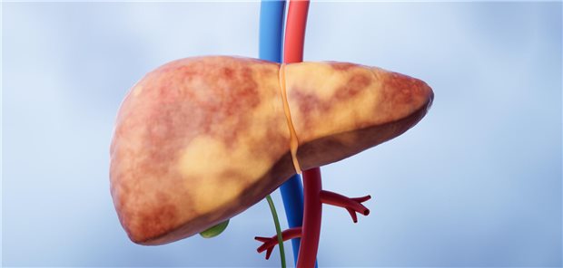 Abbildung einer Fettleber