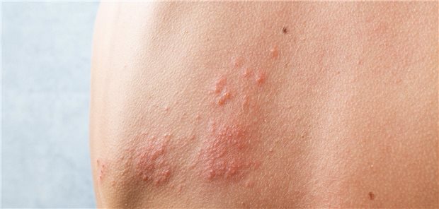 Eine Gürtelrose ist zweifelsohne schmerzhaft. Eine Impfung schützt, auch vor Rezidiven. 