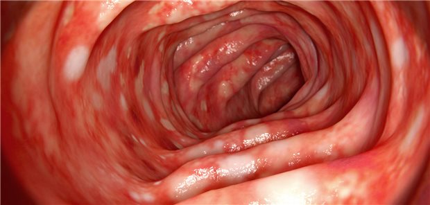 Aufnahme der Darmwand eines Patienten mit Colitis ulcerosa