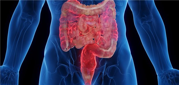 Dreidimensionale medizinische Illustration des von Morbus Crohn betroffenen Darms eines Mannes.