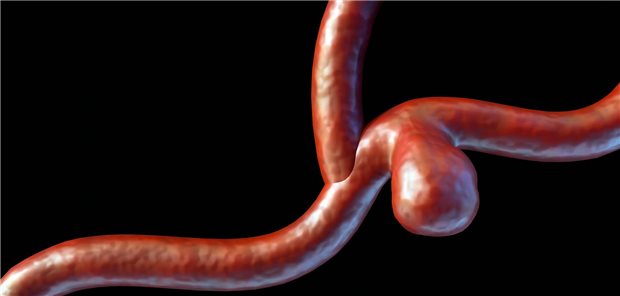 Etwa 20 Prozent der Aneurysmen betreffen periphere Arterien, wobei hier die Milz-, Leber- und Nieren-versorgenden Arterien einbezogen sind. Am häufigsten betrifft es die A. poplitea und die A. lienalis.