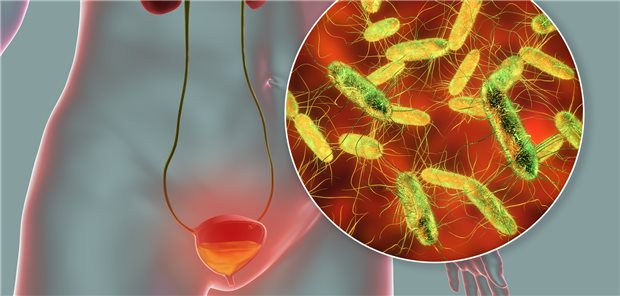 Langzeit-Antibiose nicht mehr First Line Fast jede Frau macht die Erfahrung einer Blasenentzündung. Häufigster Erreger ist E. coli.