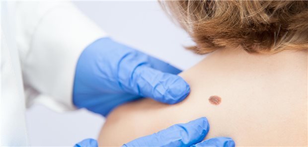 Frühe Melanome bilden wohl kein erhöhtes Risiko für Schwangere Eine Dermatologin schaut sich die Haut einer nackten Frau an, um ein mögliches Melanom zu kennzeichnen.