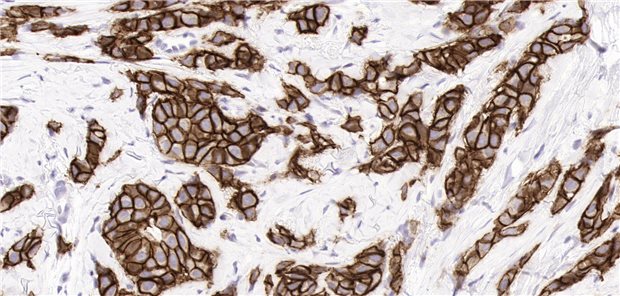 HER2-positiver Brustkrebs  Mit freundlicher Genehmigung von Prof. Dr. Annette Lebeau