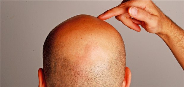 Arzneimittel gegen Haarausfall wohl mit suizidalen Gedanken assoziiert Ein Mann fasst sich mit dem Finger an seine Glatze.