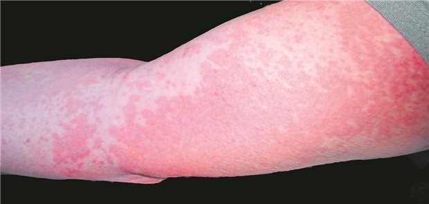 Oberarm mit Exanthem/Hautausschlag