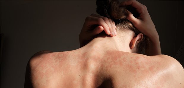 Eine Frau ist von hinten zu sehen. Sie hat am ganzen Rücken rote Flecken aufgrund einer Psoriasis. 