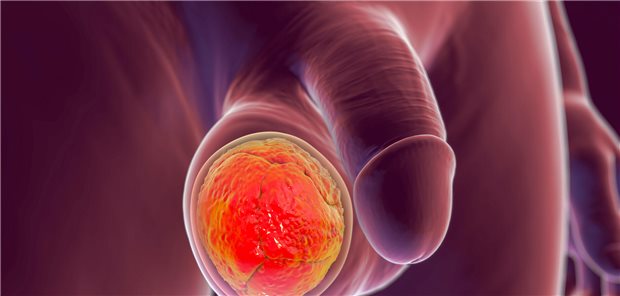 Das Symbolbild stellt eine Tumor innerhalb des rechten Hoden dar.