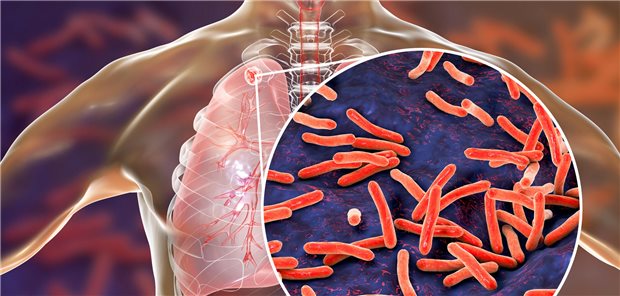 Neue Strategie zur Tuberkulose-Früherkennung Im Jahr 2023 wurden 10,8 Millionen Neuerkrankungen und 1,25 Millionen Todesfälle durch Tuberkulose registriert, mit stark heterogener globaler Verteilung.