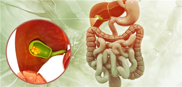 Dreidimensionale Illustration der Gallenblase mit Gallensteinen, die den Gallengang blockieren.