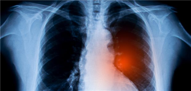 Röntgen-Aufnahme einer Lunge mit Lungenkrebs.