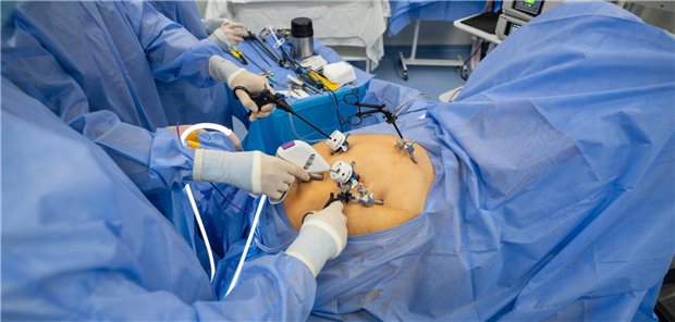 Laparoskopische Ulkuschirurgie ist der Goldstandard Die Hand des Arztes mit speziellen medizinischen Instrumenten zur Durchführung einer laparoskopischen Operation