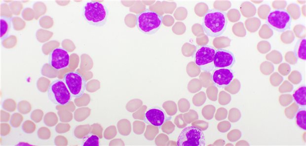 CLL: Langzeitdaten bestätigen Wirksamkeit von Ibrutinib plus Venetoclax Mikroskopieaufnahme eines Blutbild bei chronischer lymphatischer Leukämie (CLL).