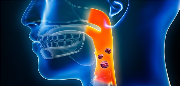 Metastasierte Kopf-Hals-Tumoren: Immuntherapie mit begrenztem Überlebensvorteil Dreidimensionale gerenderte Illustration von Pharynx- oder Kehlkopfkrebs.