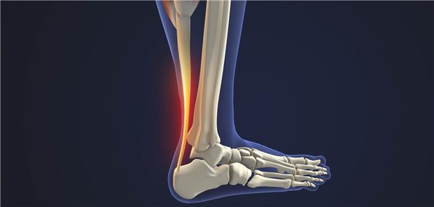 Dreidimensionale gerenderte Darstellung einer Entzündung der Achillessehne.
