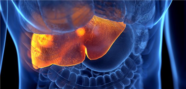 Erstlinientherapie bei fortgeschrittenem HCC: Optimale Balance zwischen Lebensqualität und Überleben Dreidimensionale gerenderte Illustration von fortgeschrittenem hepatozellulärem Karzinom.