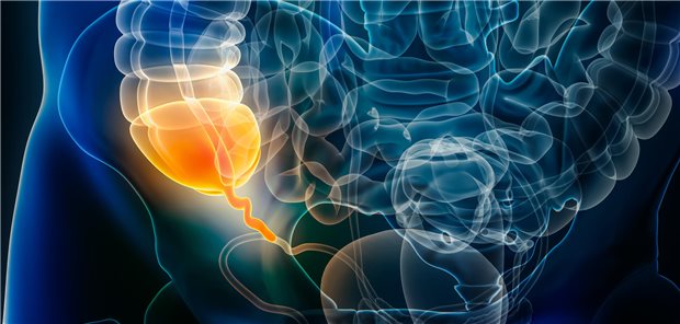 3D-Rendering einer akuten Appendizitis