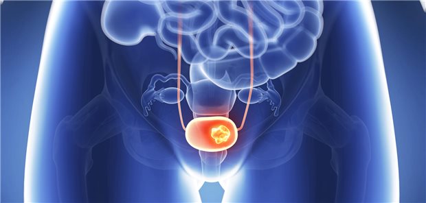 S3-Leitlinie Harnblasenkarzinom aktualisiert Symbolbild Harnblasenkarzinom
