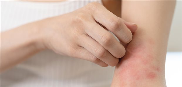Frau mit rotem Ausschlag kratzt sich am Arm.