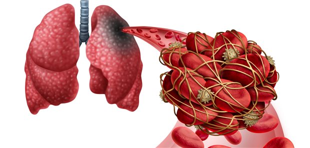 Lungenembolie. Welchen Stellenwert in der Therapie haben hier NOAK?
