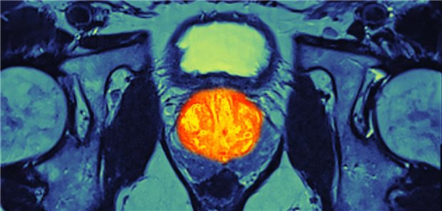 Prostatakrebs: Welche Neuerungen es in der Leitlinie gibt MRT-Aufnahme eines Patienten mit Prostata-Karzinom.