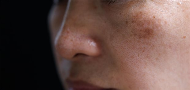 Evidenzbasierte Empfehlungen zum Management des Melasmas Nahaufnahme einer Frau mit Melasma im Gesicht.