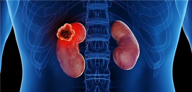 Nierenzellkarzinom: Daten zur Lebensqualität unter HIF-Inhibition vorgelegt Dreidimensionlae gerenderte medizinische Illustration von Nierenkrebs.