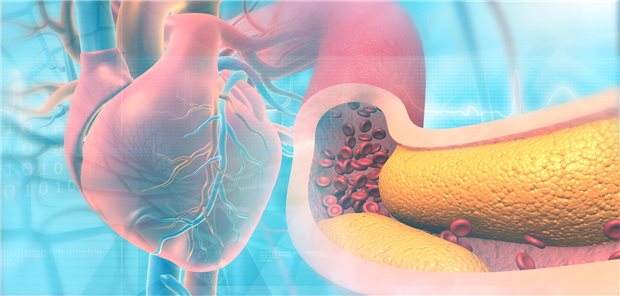 Tachometer mit Pfeil im roten Bereich, zeigt einen zu hohen Cholesterinspiegel.