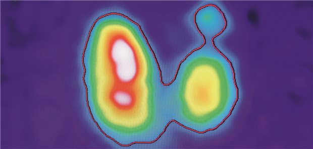 Szintigrafie eines Schilddrüsenknotens