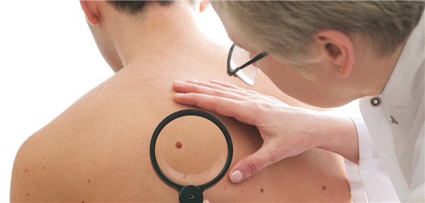 Neben bekannten Effekten wie Sehstörungen oder Kopfschmerzen fanden sich in einer Datenbank unter einer Therapie mit PDE-5-Hemmern auch vermehrt Berichte über Priapismus und Melanome.
