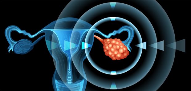 Ein Ovarialkarzinom ist mit einer Darstellung eines Uterus gekennzeichnet.