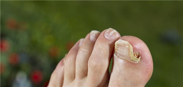 Laser gegen Nagelpilz? Nutzen laut Medizinischem Dienst „unklar“ Nahaufnahme eines Fuß mit Nagelpilzschäden