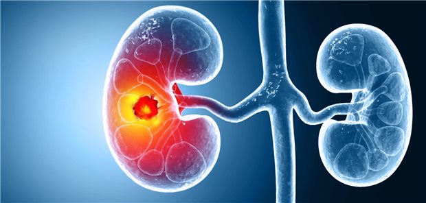 Dreidimensionale medizinische Illustration von Nierenkrebs, die das Vorhandensein eines Tumors in der Niere zeigt.