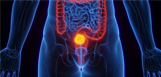 3D-Darstellung eines menschlichen Körpers mit einem kolorektalen Karzinom.