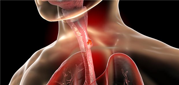 Darstellung Ösophaguskarzinom
