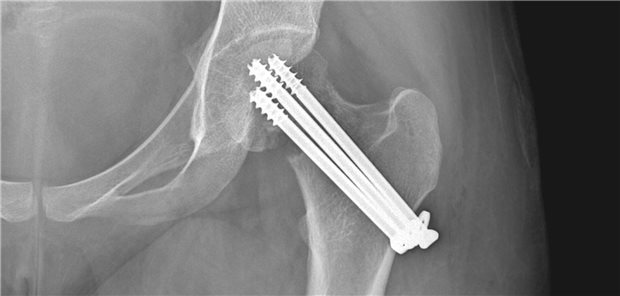 Eine Fraktur wird fixiert.