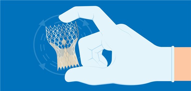 Patienten mit einer Aortenstenose und TAVI haben ein geringeres Mortalitätsrisiko als Patienten, die einen offenen Aortenklappenersatz bekommen haben.