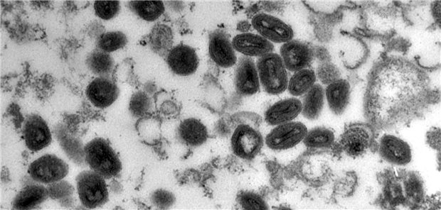 Uni Würzburg will Arzneien gegen Affenpocken entwickeln Pockenviren – hier unter dem Mikroskop – zählen zu den tödlichsten Krankheitserregern der Menschheitsgeschichte. Nicht ganz so gefährlich, aber dennoch beunruhigend ist der derzeitige Ausbruch der Affenpocken.