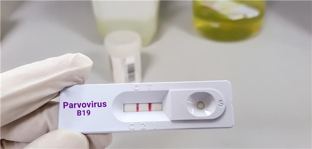 Positiver Test auf Parvovirus B 19: Den hatte eine Kindergärtnerin im Krankenhaus erhalten. Sachverständige bestätigten, dass die Rötelninfektion bei ihr ursächlich für CFS war.